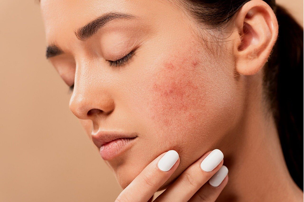 Acne - Natural Remedies