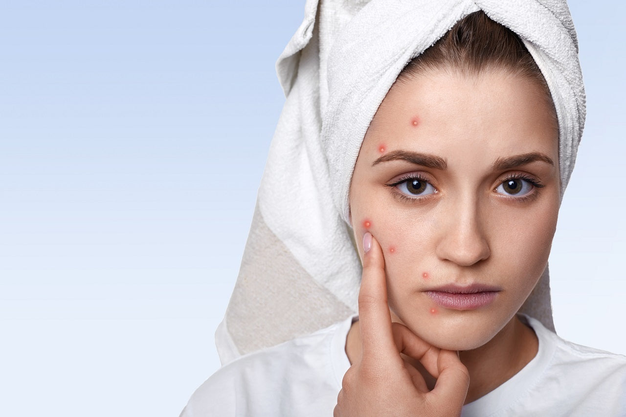 7 Simple Home Remedies to Get Rid of Pimples Quickly